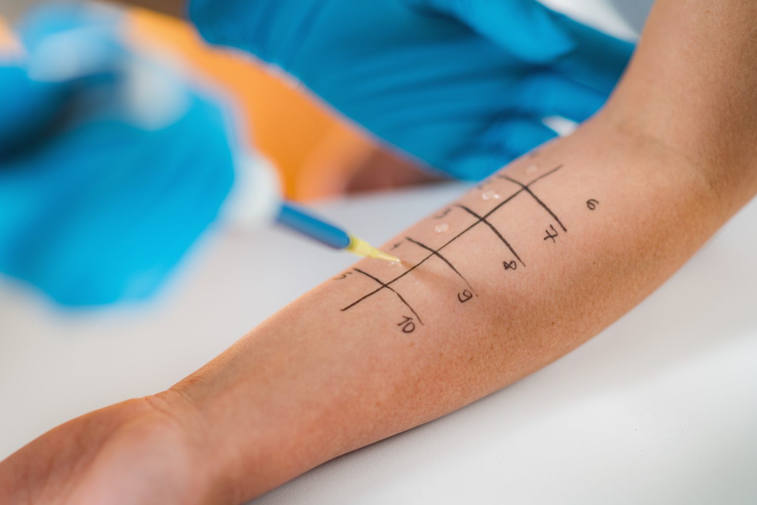 Austestung von Allergien am Arm