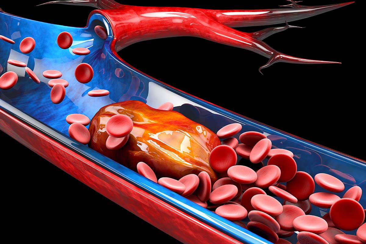 Wie erkenne ich eine Thrombose?Diagnostik und Therapie Wie erkenne ich eine Thrombose?Diagnostik und Therapie
