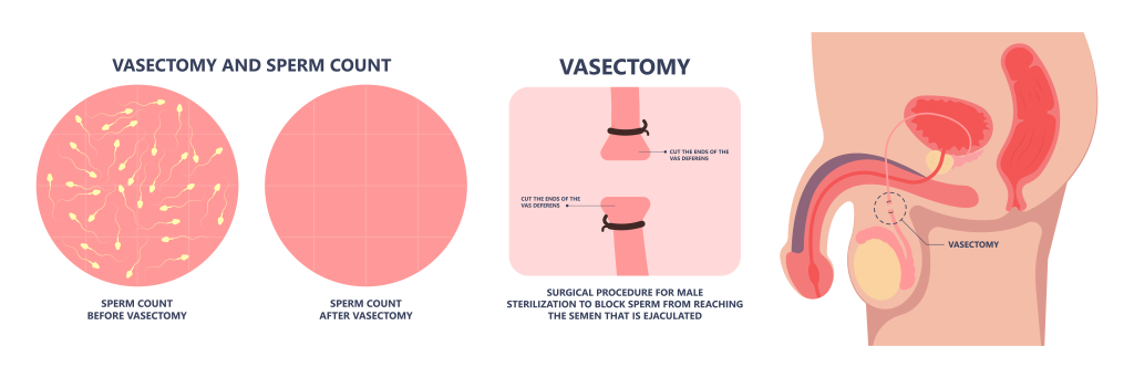 Vasektomie - Sterilisation beim Mann - Was passiert bei einer Vasektomie?