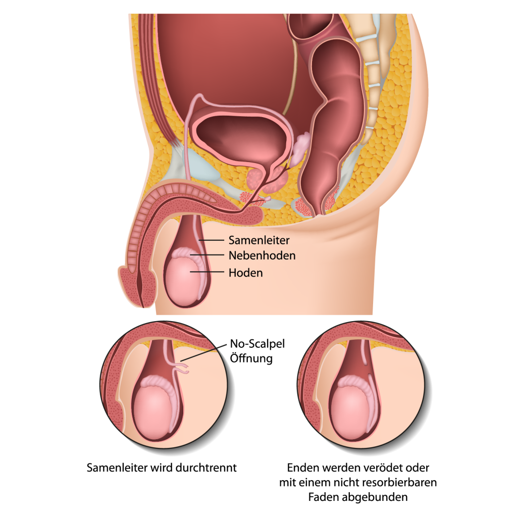 Vasektomie - Sterilisation beim Mann