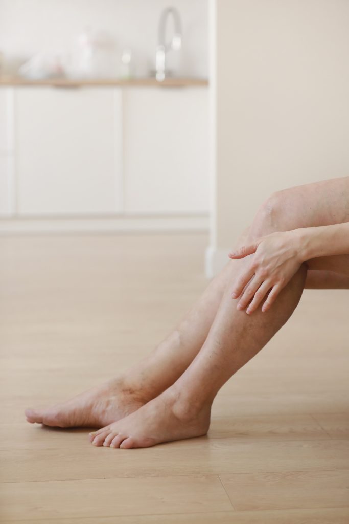 Krampfadern - hochliegende Adern an den Beinen behandeln