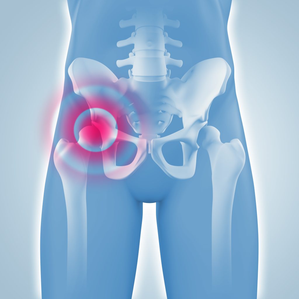 Wieviel Kg Darf Man Nach Leistenbruch Op Heben Leistenbruch OP | Finden Sie einen Arzt in Ihrer Nähe!